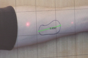 Fake Arm Wound with laser scale
