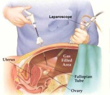 Laparoscopy