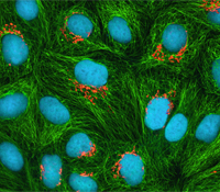 Cervical cancer cells