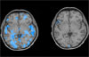 Combined Imaging and Genetics Studies